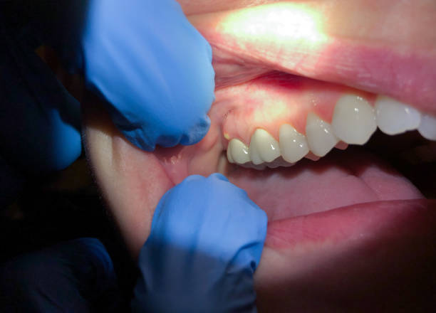 Best Emergency Treatment for Dental Infections or Abscesses in Pioneer, OH