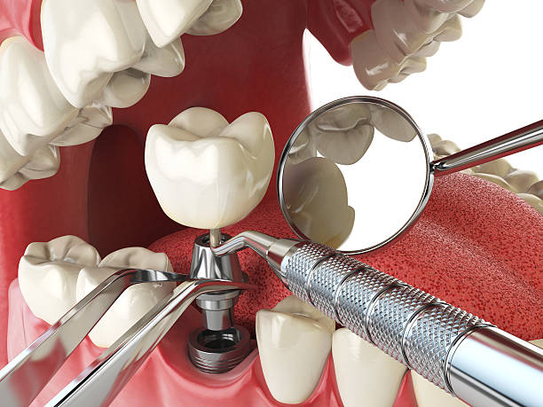Best Emergency Tooth Extraction in Pioneer, OH